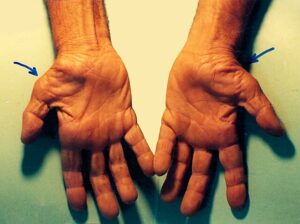 Differentiating The Imposters From Carpal Tunnel Syndrome